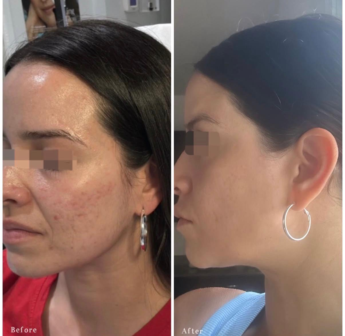 Side-by-side comparison of a woman's face before and after skin treatment, showing improvement in skin texture and reduction of acne scars.