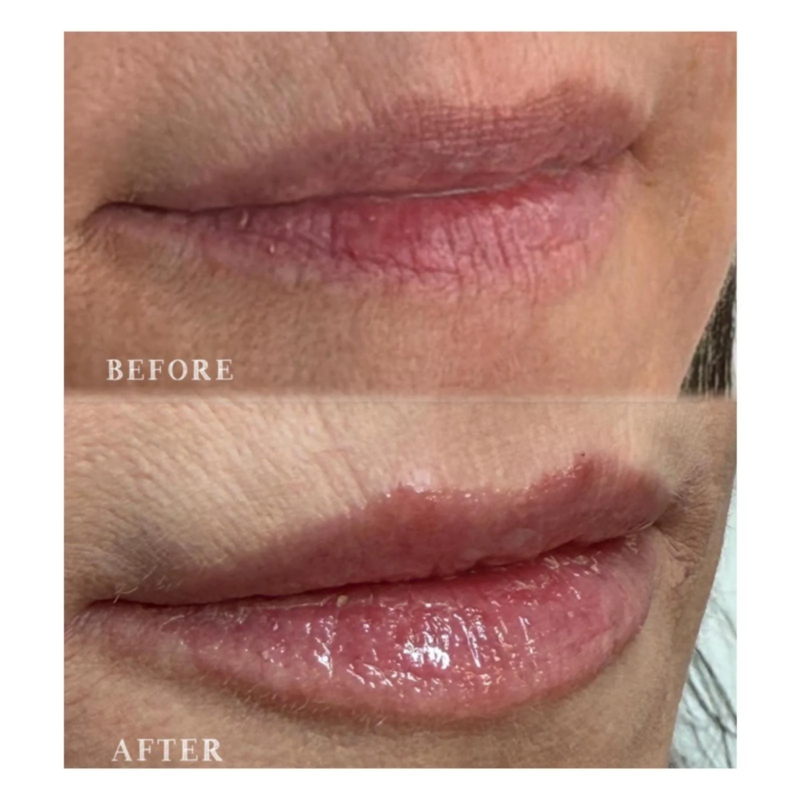 Close-up photo of lips showing before and after cosmetic treatment. The top part labeled 'BEFORE' has lips with fine lines, dryness, and uneven texture. The bottom part labeled 'AFTER' shows lips that are smoother, more moisturized, and have a health