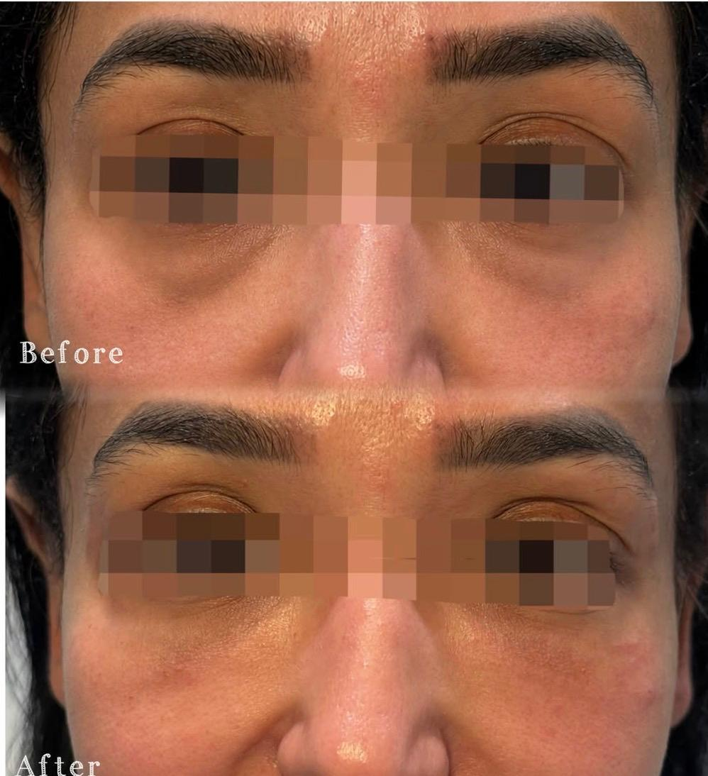 Close-up of a person's face showing before and after images of a cosmetic treatment to reduce under-eye puffiness. The 'before' image shows noticeable under-eye bags, while the 'after' image shows smoother, more refreshed skin under the eyes.