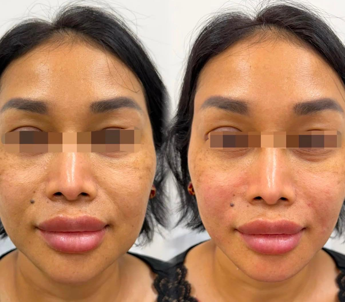 Side-by-side comparison of a woman's face before and after skincare treatment, showing improvements in skin texture and clarity.