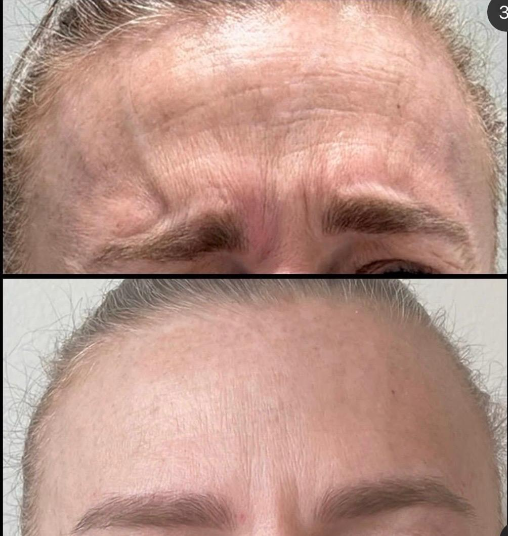 Close-up of a woman's forehead, showing before and after images of a cosmetic procedure, with the after image displaying smoother skin.