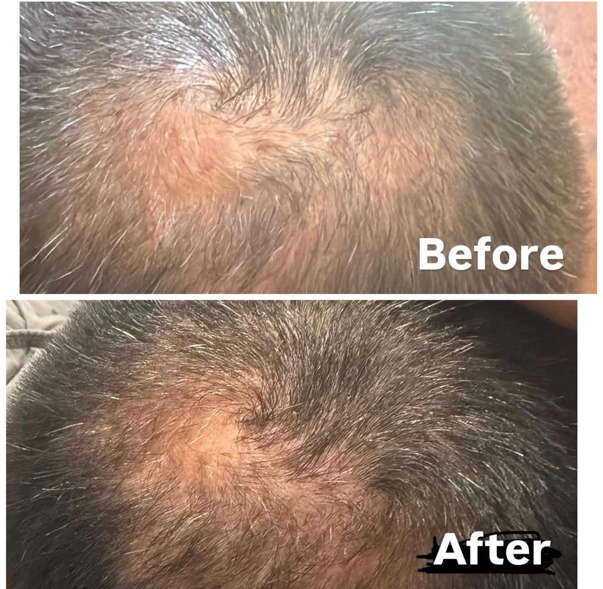 Side-by-side comparison of a scalp before and after hair treatment showing increased hair density and improved appearance.