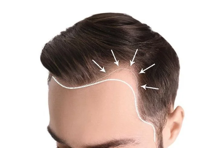 Close-up of a man's head with lines and arrows indicating a hairline design for hair transplantation or styling.