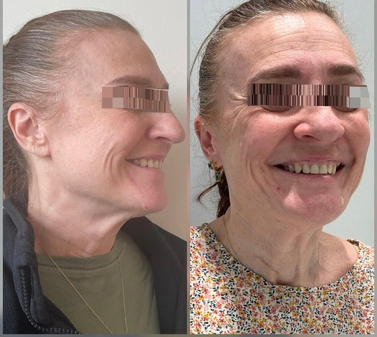 Side-by-side comparison photo of a woman before and after a skincare treatment, smiling in both images. The woman has light skin, gray hair, and is wearing different outfits in each photo.