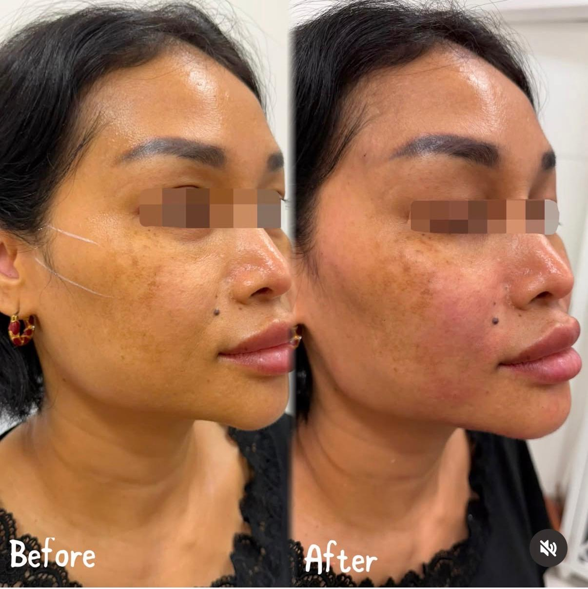 Side-by-side comparison of a woman's face labeled 'Before' and 'After', showing skin improvement, with the 'After' image indicating clearer, more even skin tone.