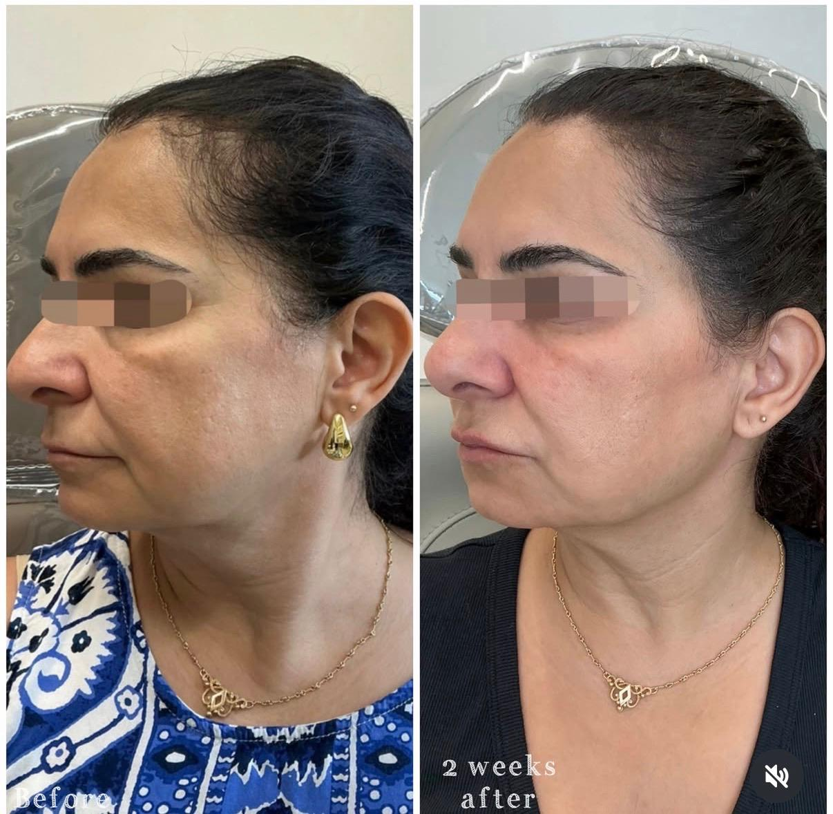 Side-by-side comparison of a woman's face before and after two weeks of skin treatment, showing improvements in skin texture and clarity.