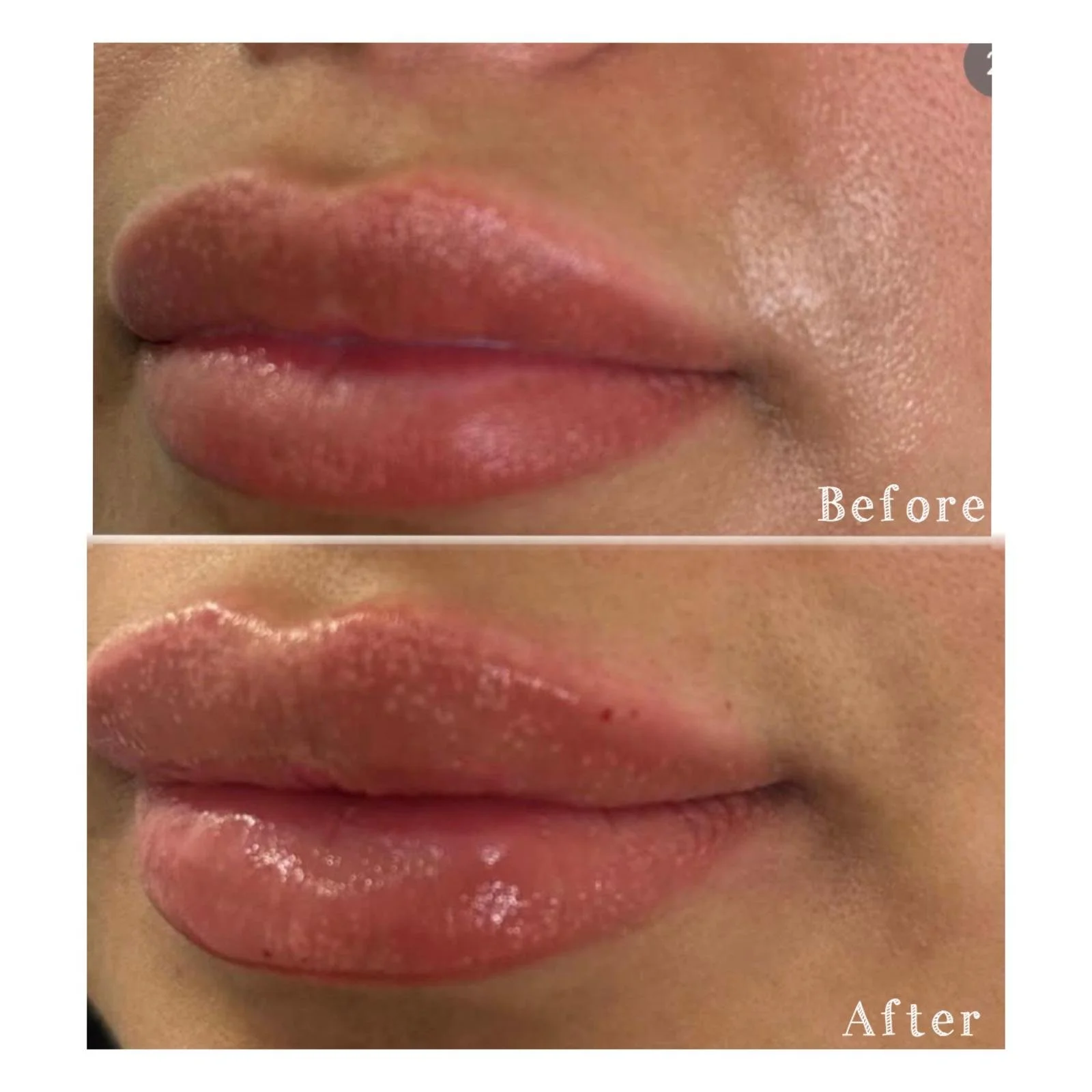 Close-up of a person's lips showing a before and after comparison, with the 'before' label on top and the 'after' label on the bottom. The lips appear to have undergone some sort of cosmetic or skincare treatment.