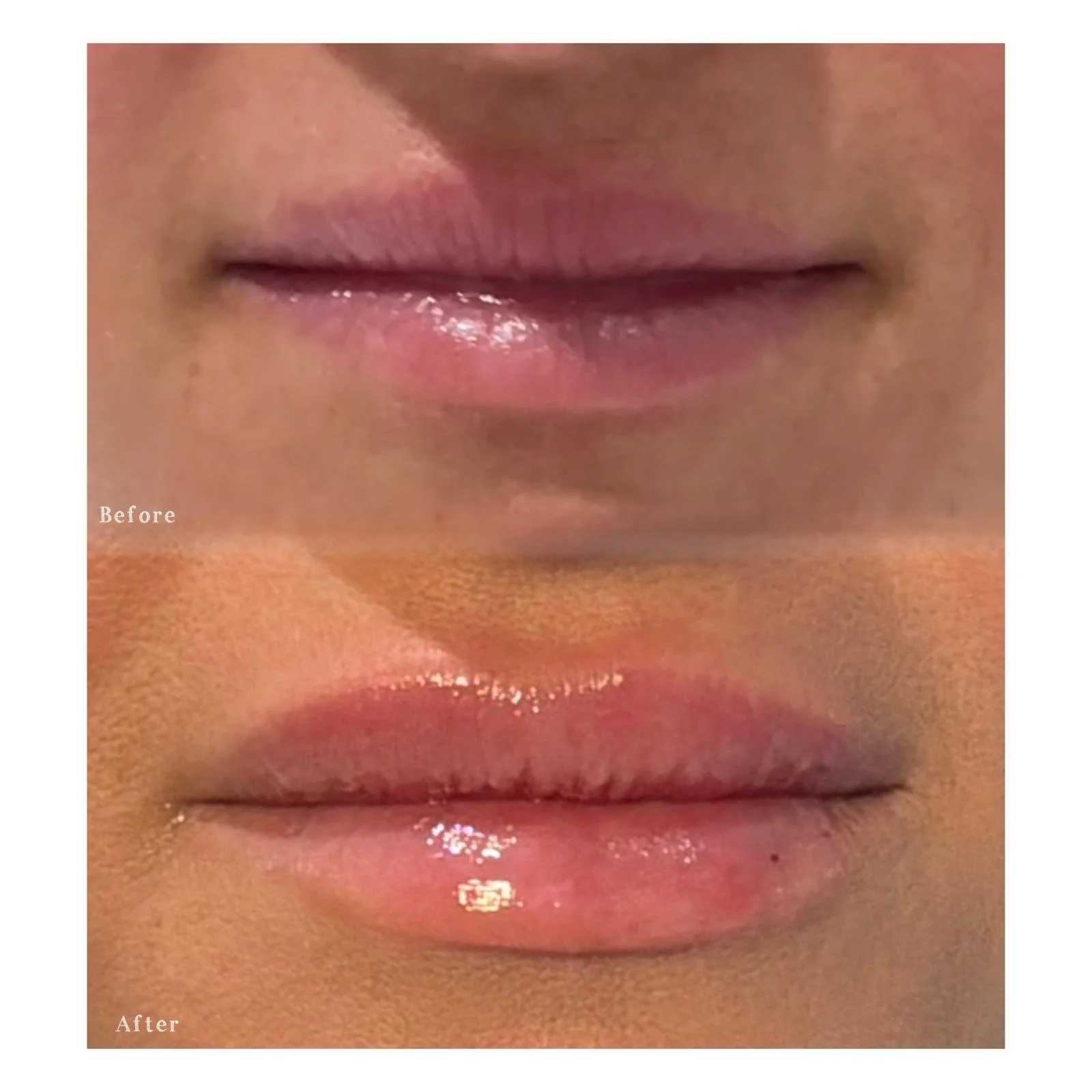 Close-up of lips before and after cosmetic treatment, showing improved fullness and smoothness.