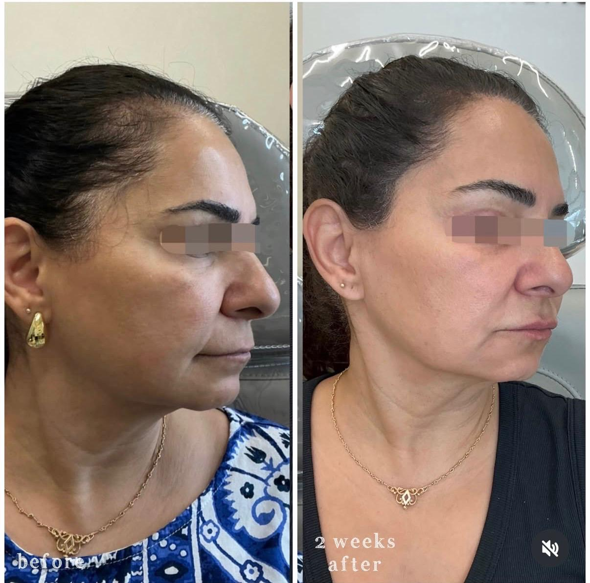 Side-by-side comparison of a woman's face before and after 2 weeks of a skin treatment. The left image shows her with uneven skin tone and some skin imperfections, while the right image shows clearer, smoother skin with improved tone and texture. The