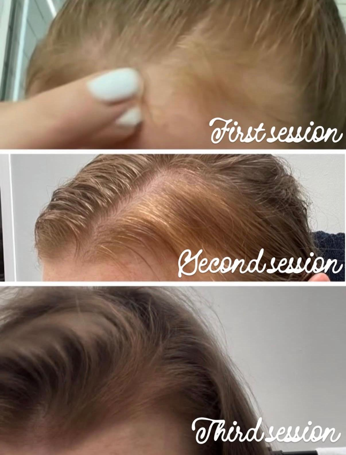 Sequence of three close-up images showing the progression of hair growth over three sessions, labeled as first session, second session, and third session.