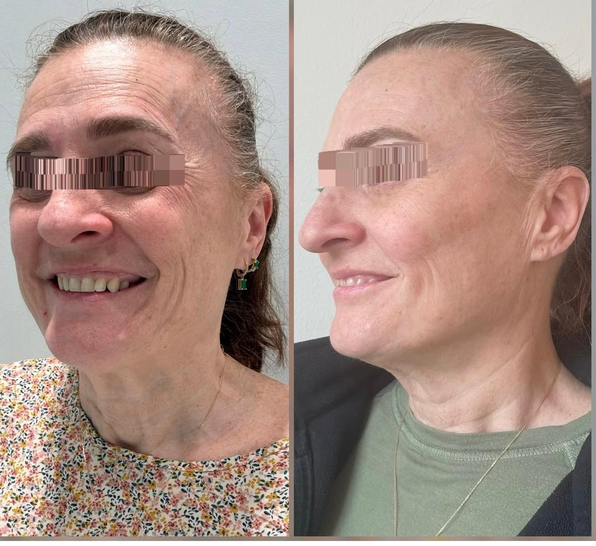 Side-by-side comparison photo of a woman before and after a cosmetic procedure, showing improved skin texture, reduced wrinkles, and a more youthful appearance.