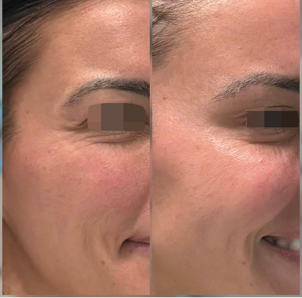 Before and after close-up of a woman's face, highlighting reduced wrinkles around the eye area, indicating skincare or cosmetic treatment results.