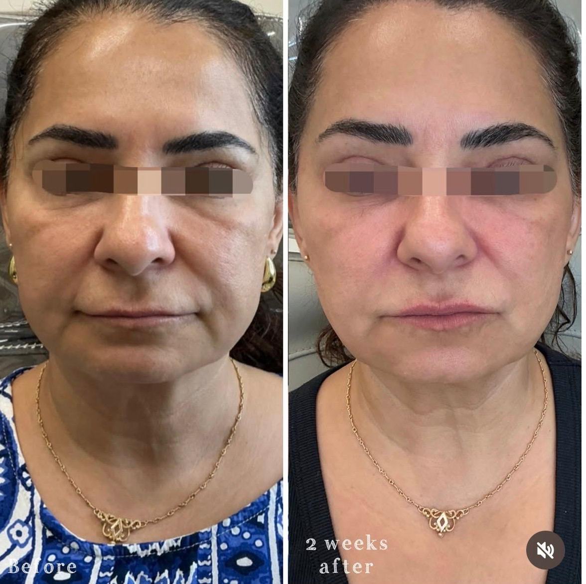 Side-by-side comparison of a woman's face before and after two weeks of treatment, showing improved skin texture and reduced wrinkles on the face.