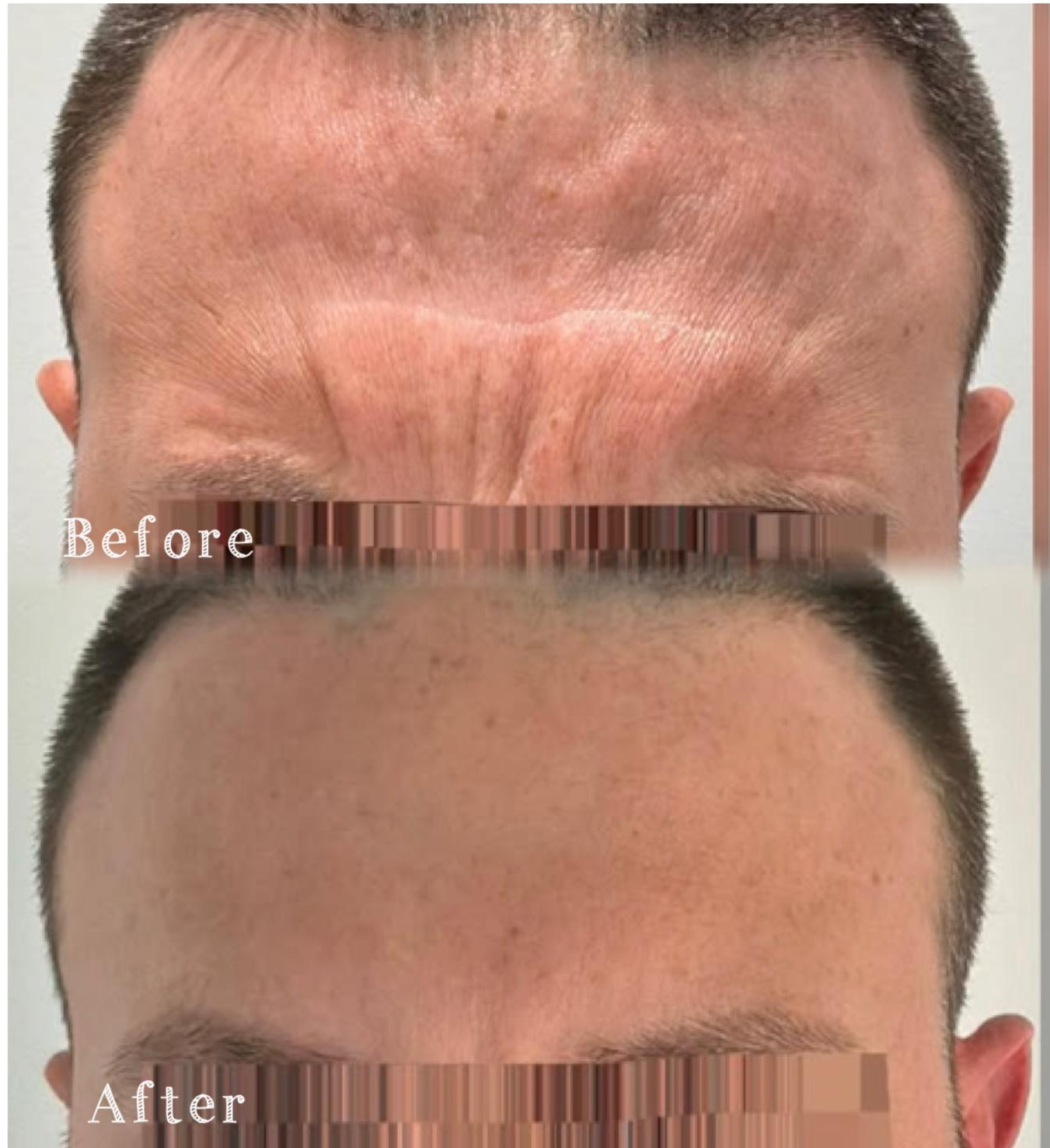 Comparison image showing a person's forehead before and after a treatment, with the 'before' showing wrinkles and textured skin, and the 'after' showing smooth, wrinkle-free skin.