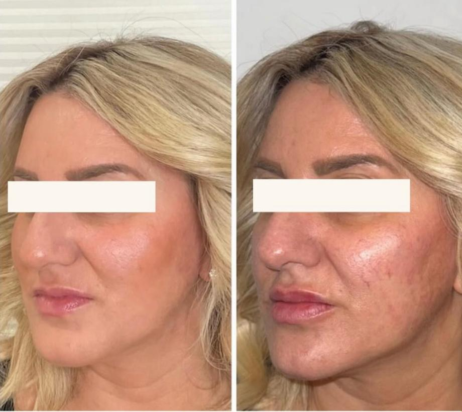Side-by-side comparison of a woman's face showing improvement in skin condition, with smoother, clearer skin on the left and more textured, blemished skin on the right.