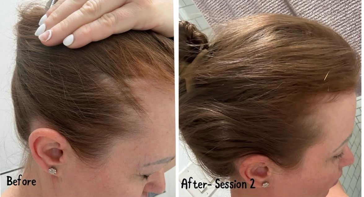 Side-by-side comparison of a woman's hair before and after a hair treatment session. The 'before' image shows her hair with visible thinning at the hairline, while the 'after' image shows her hair appearing thicker and fuller.