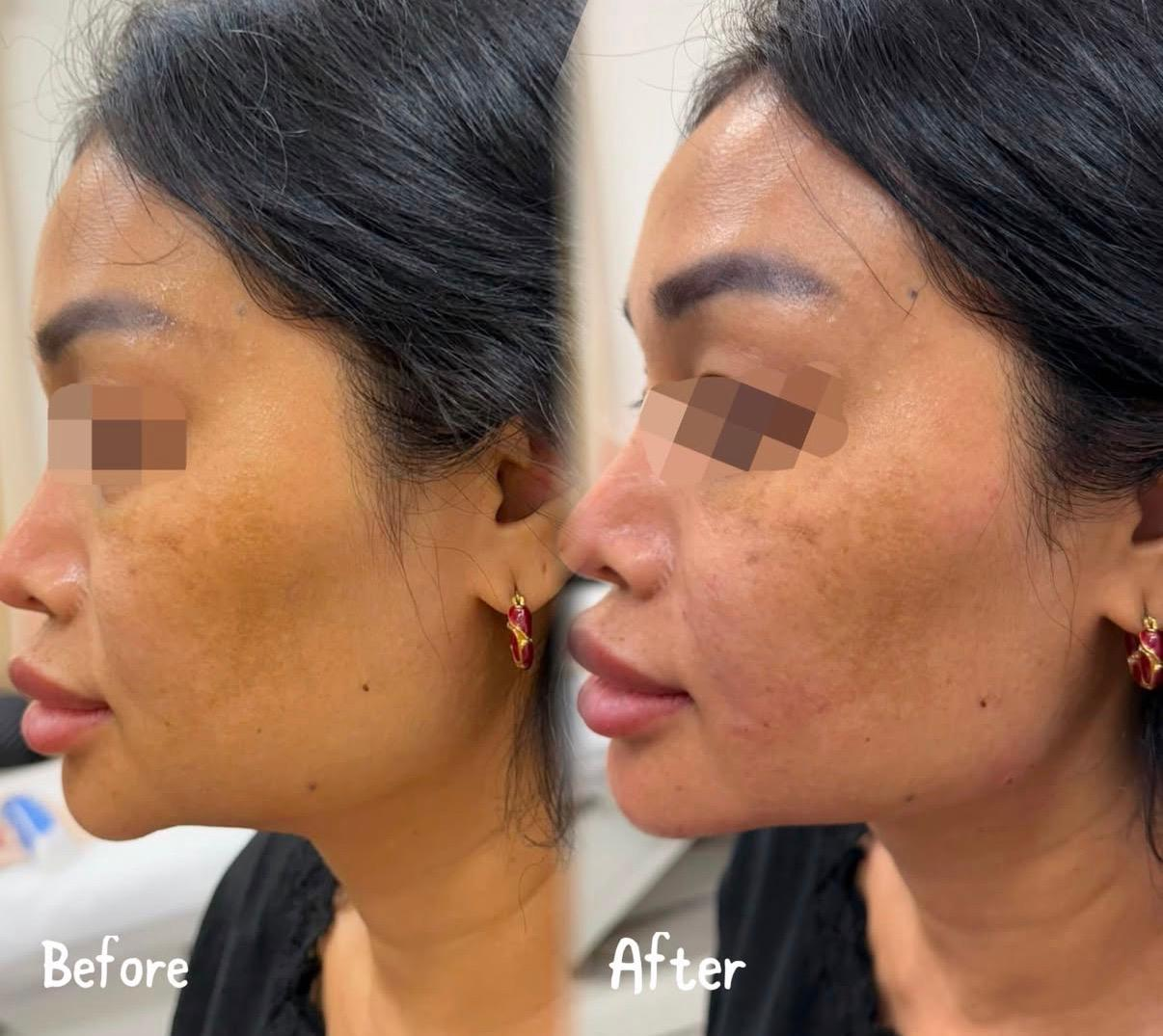 Side-by-side comparison of a woman's face before and after skincare treatment showing improved skin texture, reduced pigmentation, and clearer complexion.