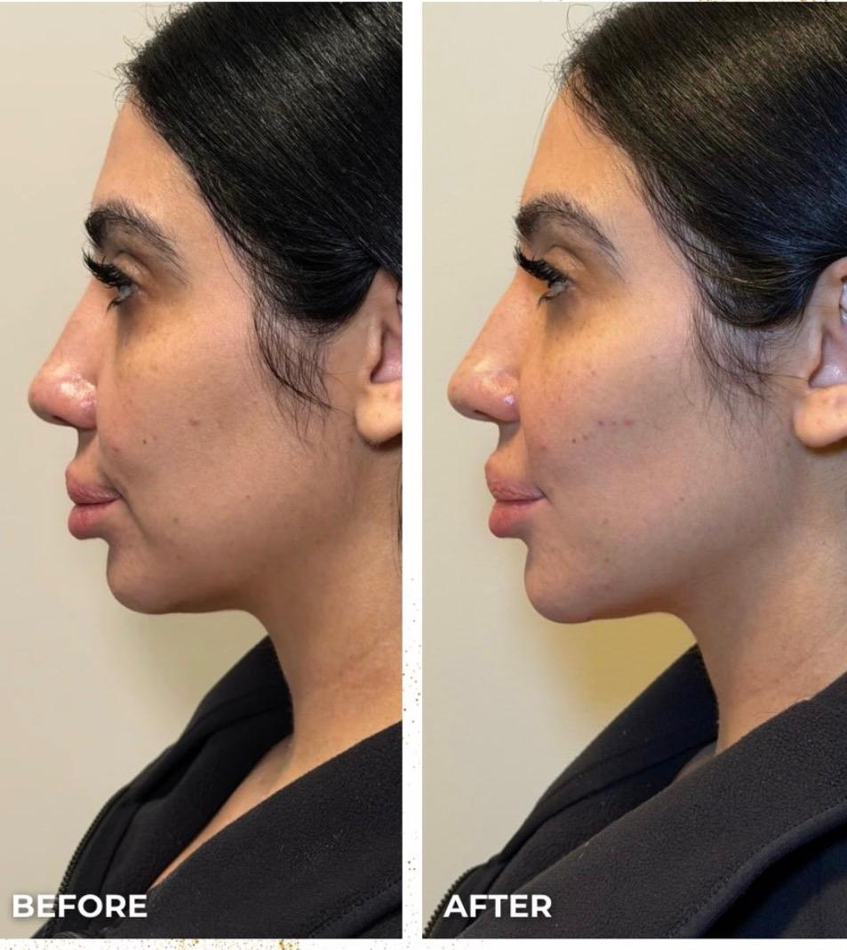 Side-by-side comparison of a woman's profile before and after skincare or cosmetic treatment, showing improved skin condition in the after image.