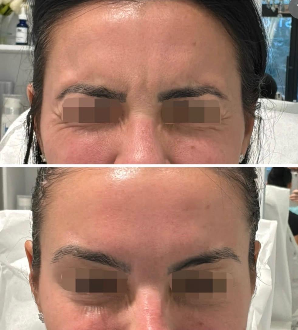 Before and after images of a woman's forehead showing skin improvement after (likely) a cosmetic treatment, with her eyes blurred for privacy.