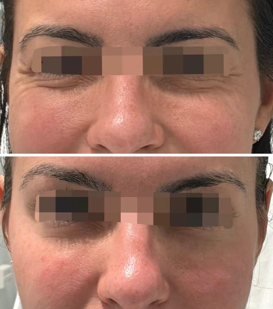 Close-up of a woman's face showing before and after cosmetic treatment, focusing on the area around her nose and cheeks.