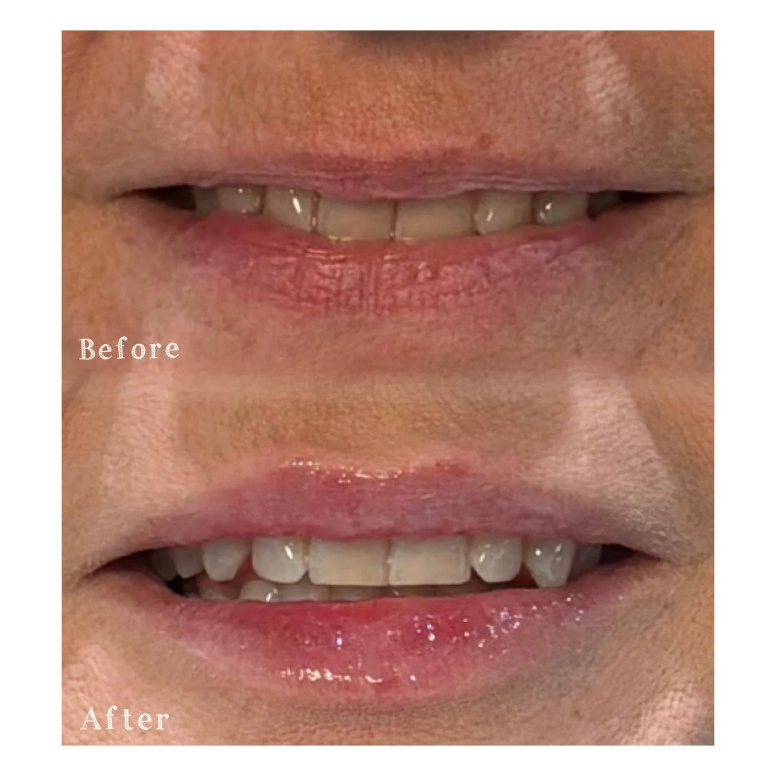 Close-up of a person's mouth showing dental work before and after. The top image labeled 'Before' shows uneven, discolored teeth. The bottom image labeled 'After' displays improved, whiter teeth with a more aligned appearance.