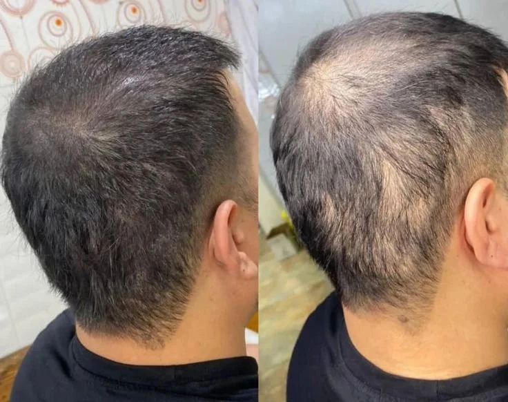 Comparison of a man's hair before and after hair restoration or treatment, showing increased hair density on the left and thinning on the right.