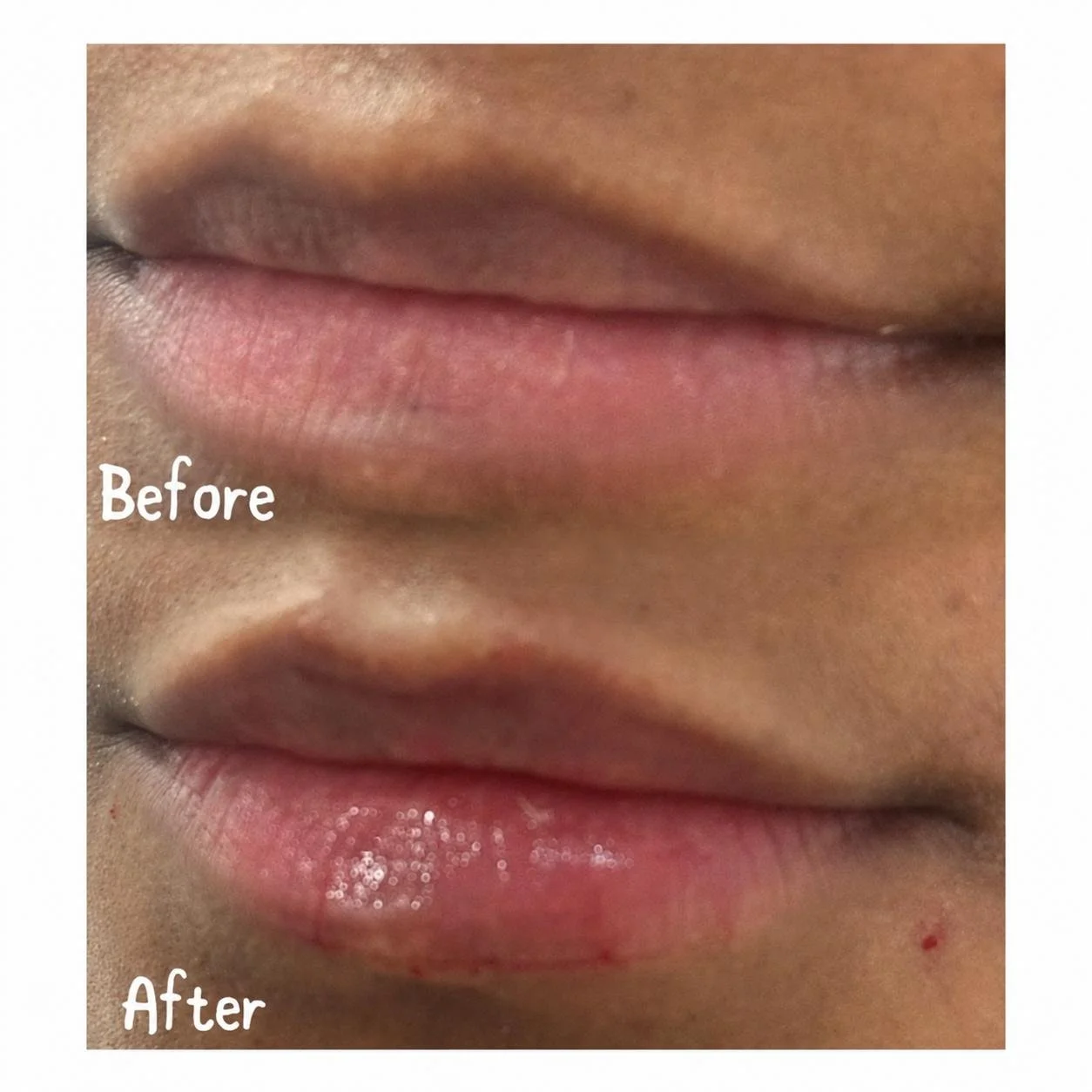 Close-up of a person's lips showing the before and after results of a cosmetic or dental procedure. The 'before' top image displays lips with a natural appearance, while the 'after' bottom image shows lips with a slightly altered appearance, possibly