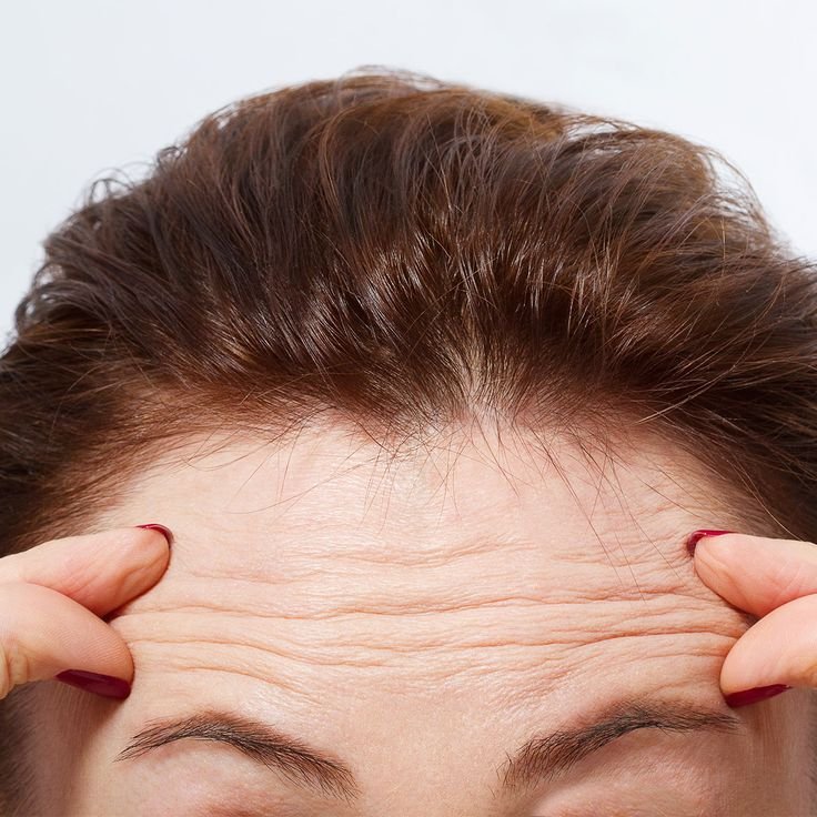 A woman with brown hair pulling back her hair to reveal forehead wrinkles.