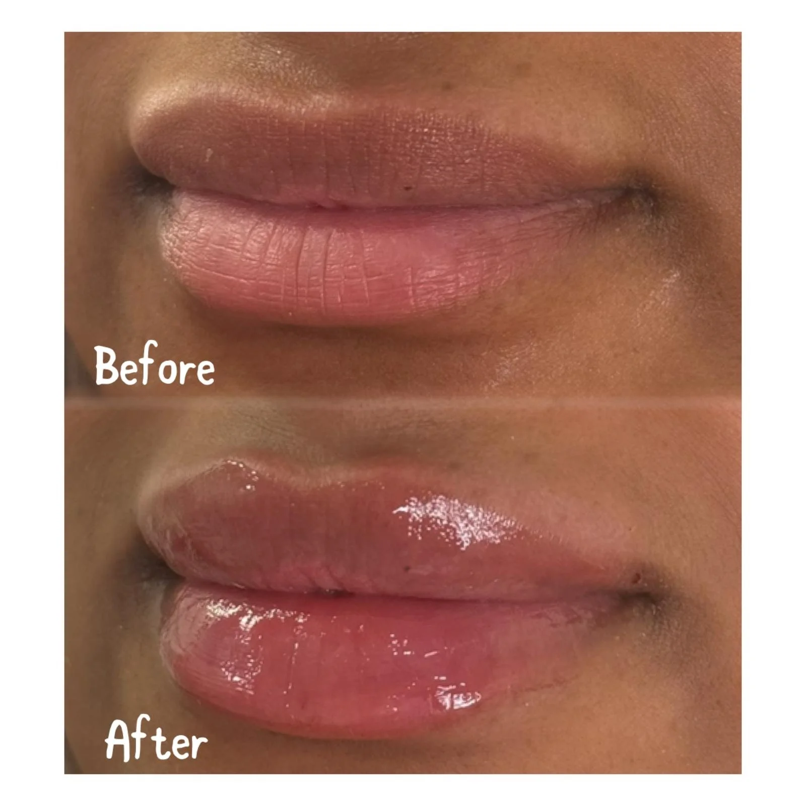 Close-up of lips showing before and after results, with the top image labeled 'Before' and the bottom 'After,' highlighting changes in lip appearance.