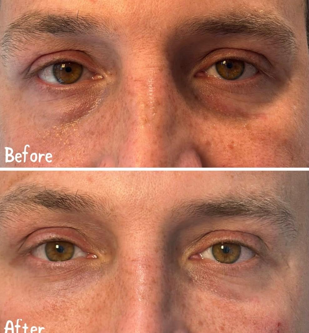Close-up of a person's eyes showing a before and after comparison. The top image shows dark circles and puffiness under the eyes, while the bottom image shows reduced puffiness and dark circles, indicating an improvement.