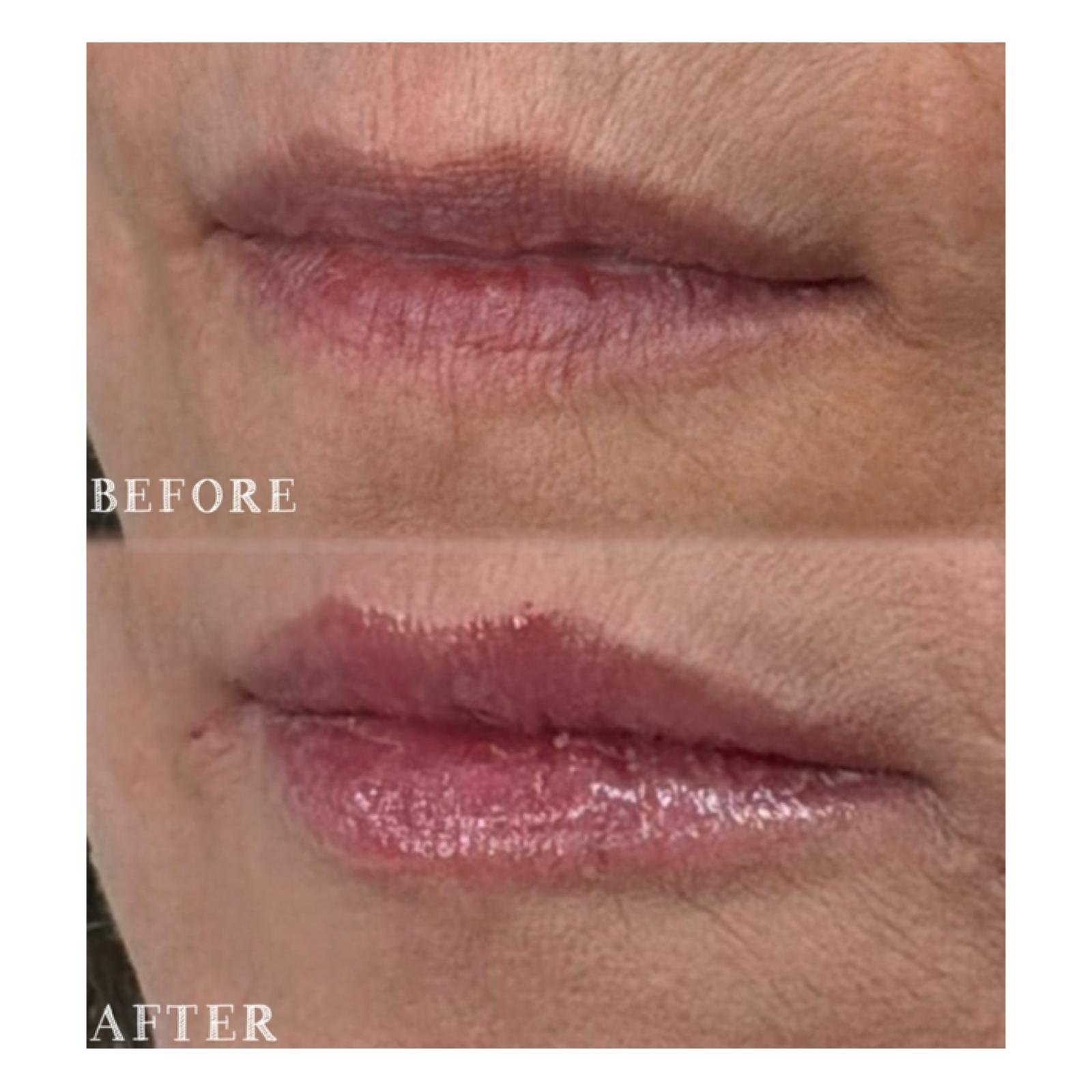 Close-up of lips showing before and after lip treatment, with the top half labeled 'BEFORE' and the bottom half labeled 'AFTER'.