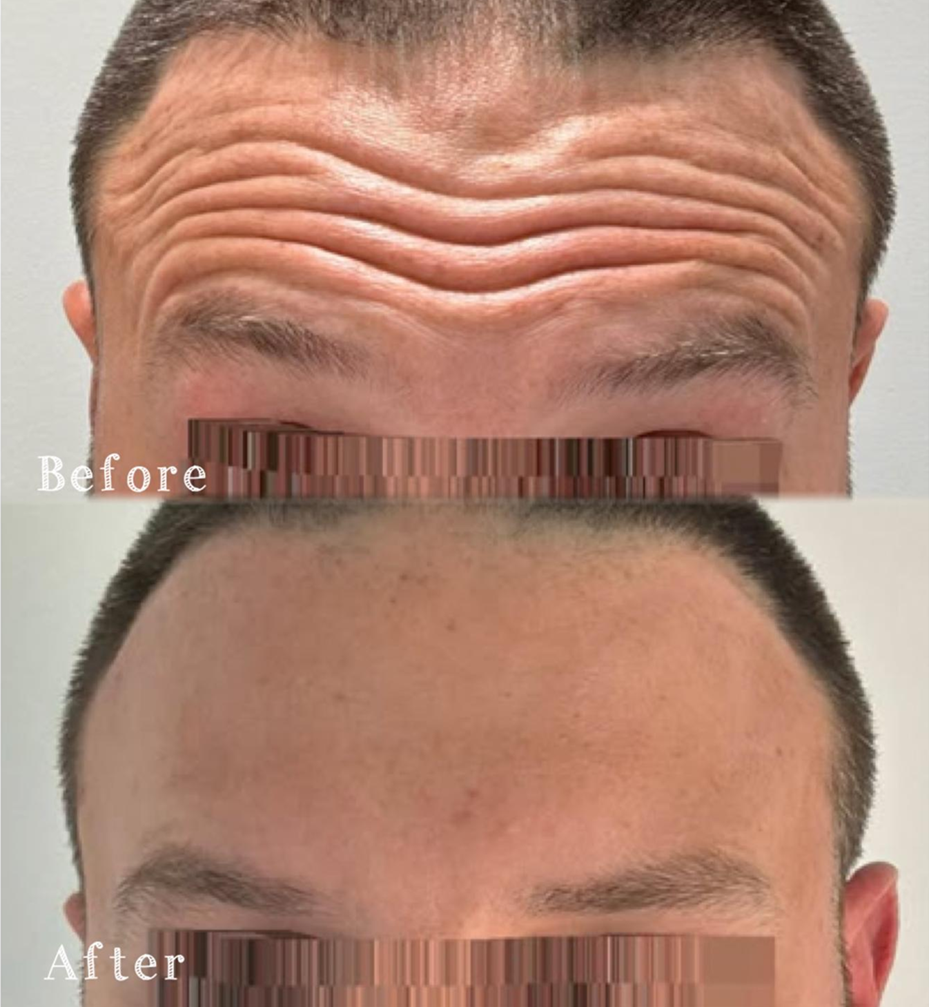 Comparison of a person's forehead before and after a cosmetic procedure showing reduced wrinkles in the after image.