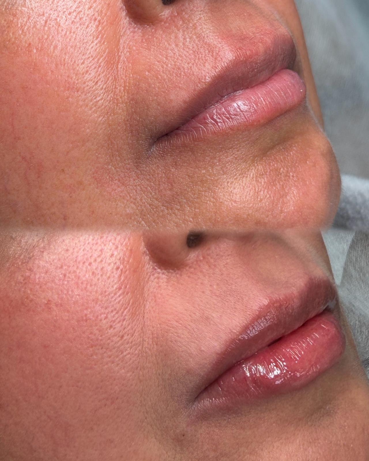 Close-up image of a person's lips, nose, and cheek, showing smooth skin texture and natural features.