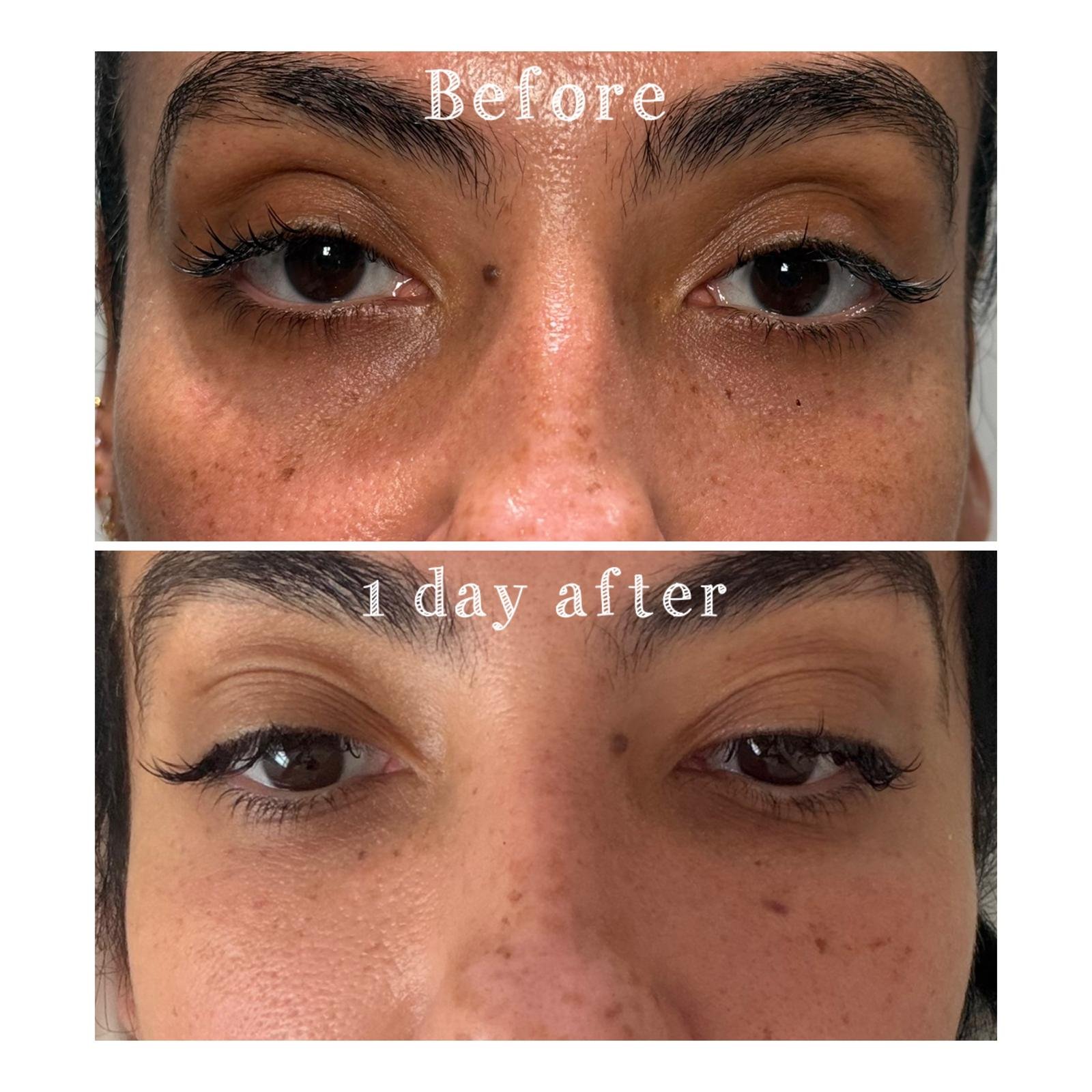 Side-by-side comparison of a woman's face showing the area around her eyes before and one day after a skincare treatment. The 'before' image shows she has under-eye dark circles and uneven skin texture. The 'after' image shows improved skin clarity a