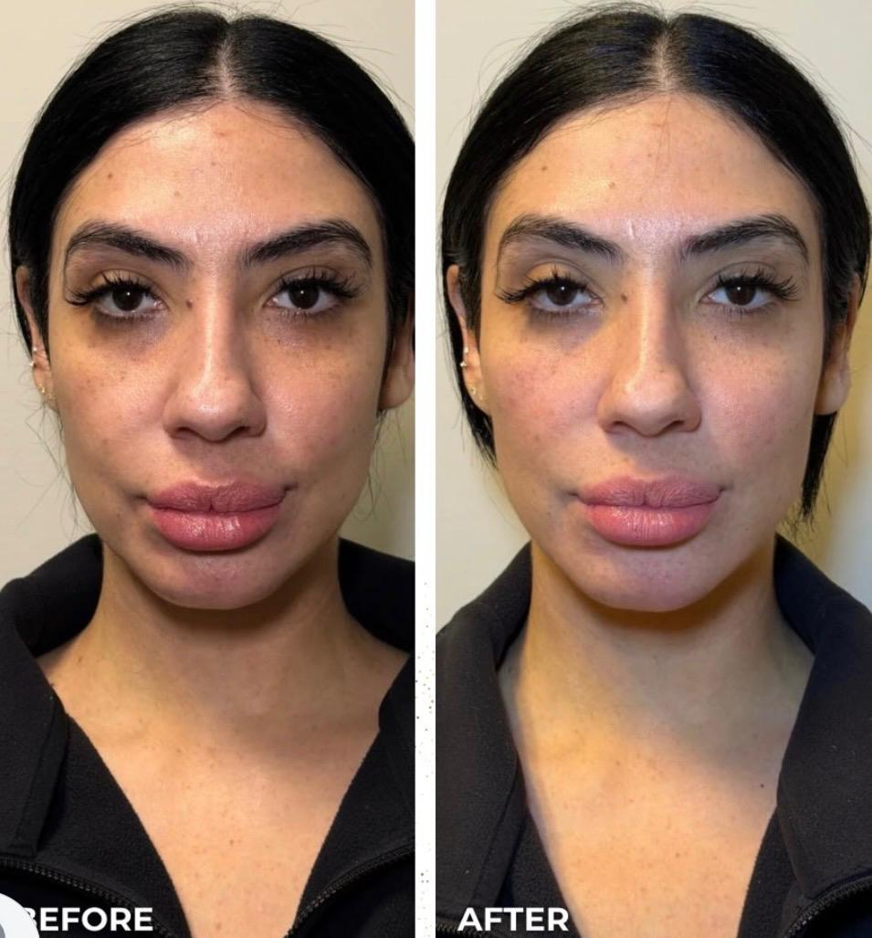 Side-by-side comparison of a woman before and after skincare treatment showing improved skin texture and reduced pigmentation.
