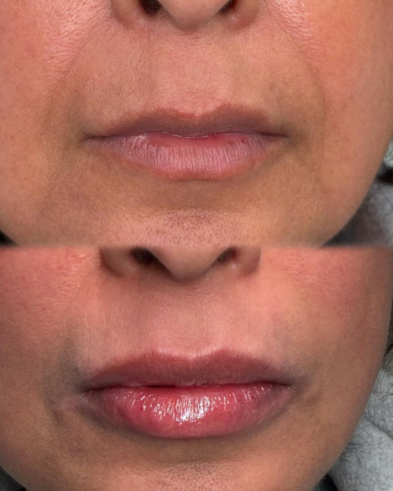 Close-up images showing the progression of lip treatment, with the top image showing natural lips, the middle image showing lips with increased volume, and the bottom image showing glossy, moisturized lips.