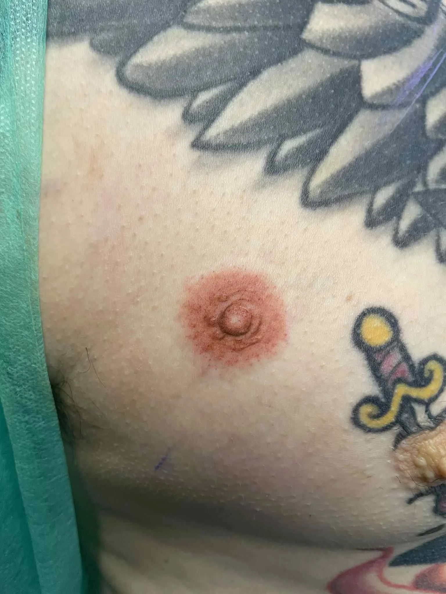 Close-up of a person's chest showing a nipple surrounded by redness, with visible tattoos on the skin.