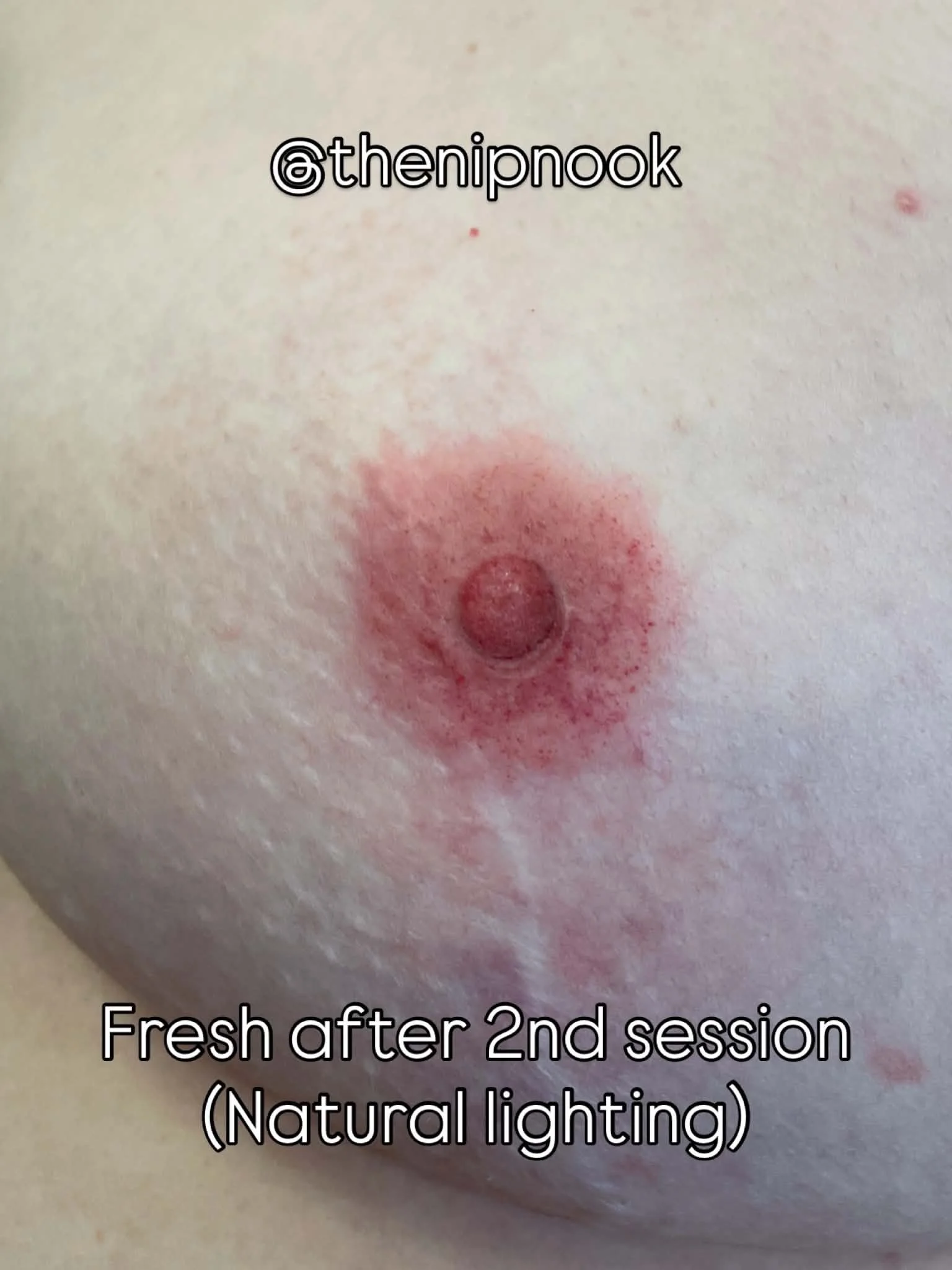 Close-up of a pierced nipple with some redness and healing signs, captioned about fresh piercing after 2nd session under natural lighting.