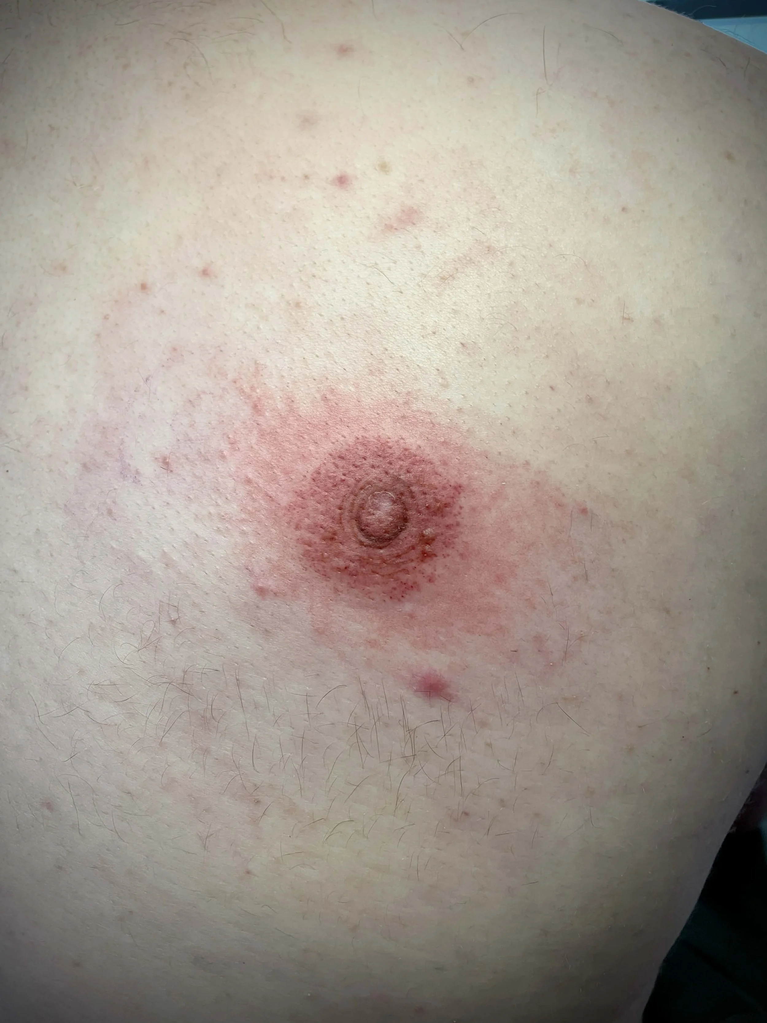 Close-up of a human breast with visible redness, swelling, and a lump in the nipple area.