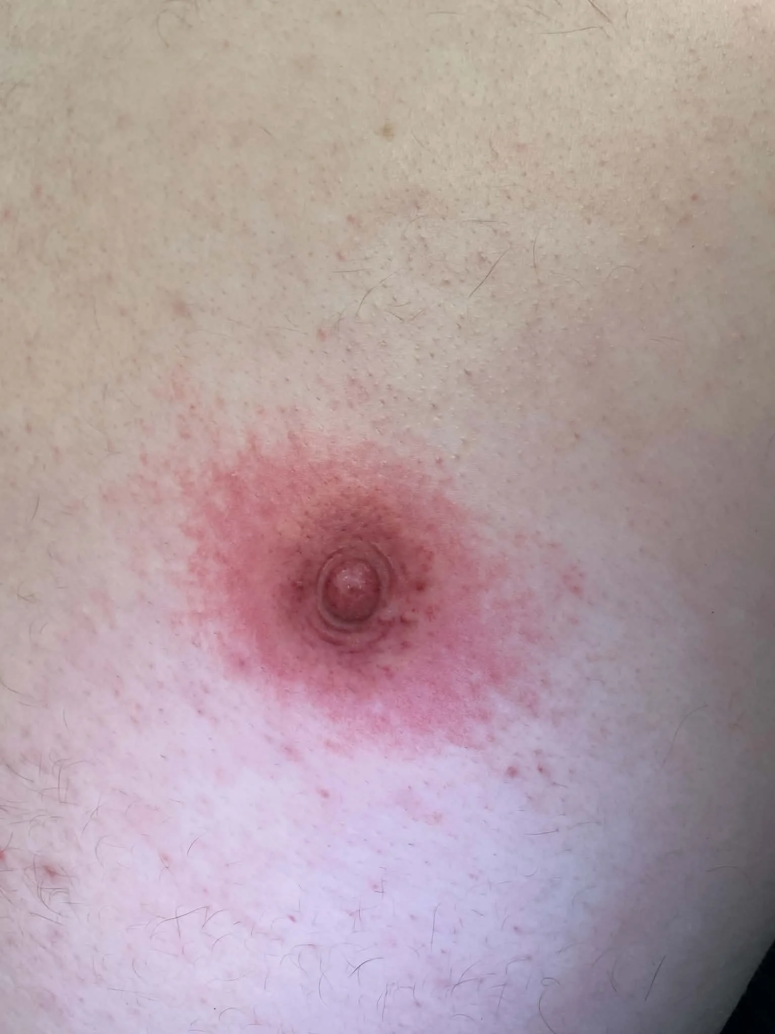 Close-up of human skin with a small mole, redness, and circular skin irritation near the nipple area.