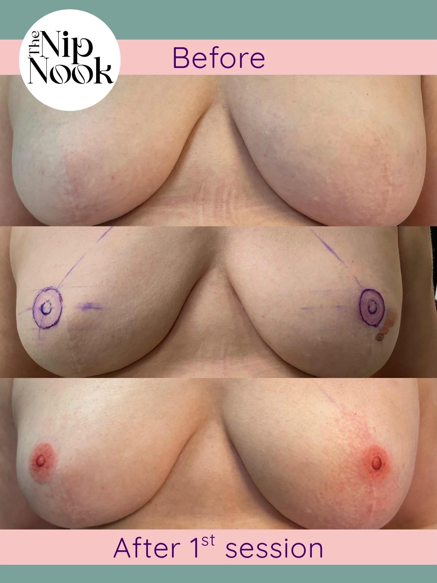 Comparison of a woman's breasts before and after a cosmetic enhancement procedure. The top image shows the breasts before the procedure, the middle image shows markings made on the breasts in preparation for the procedure, and the bottom image shows the breasts after the first session with visible changes in size and shape.