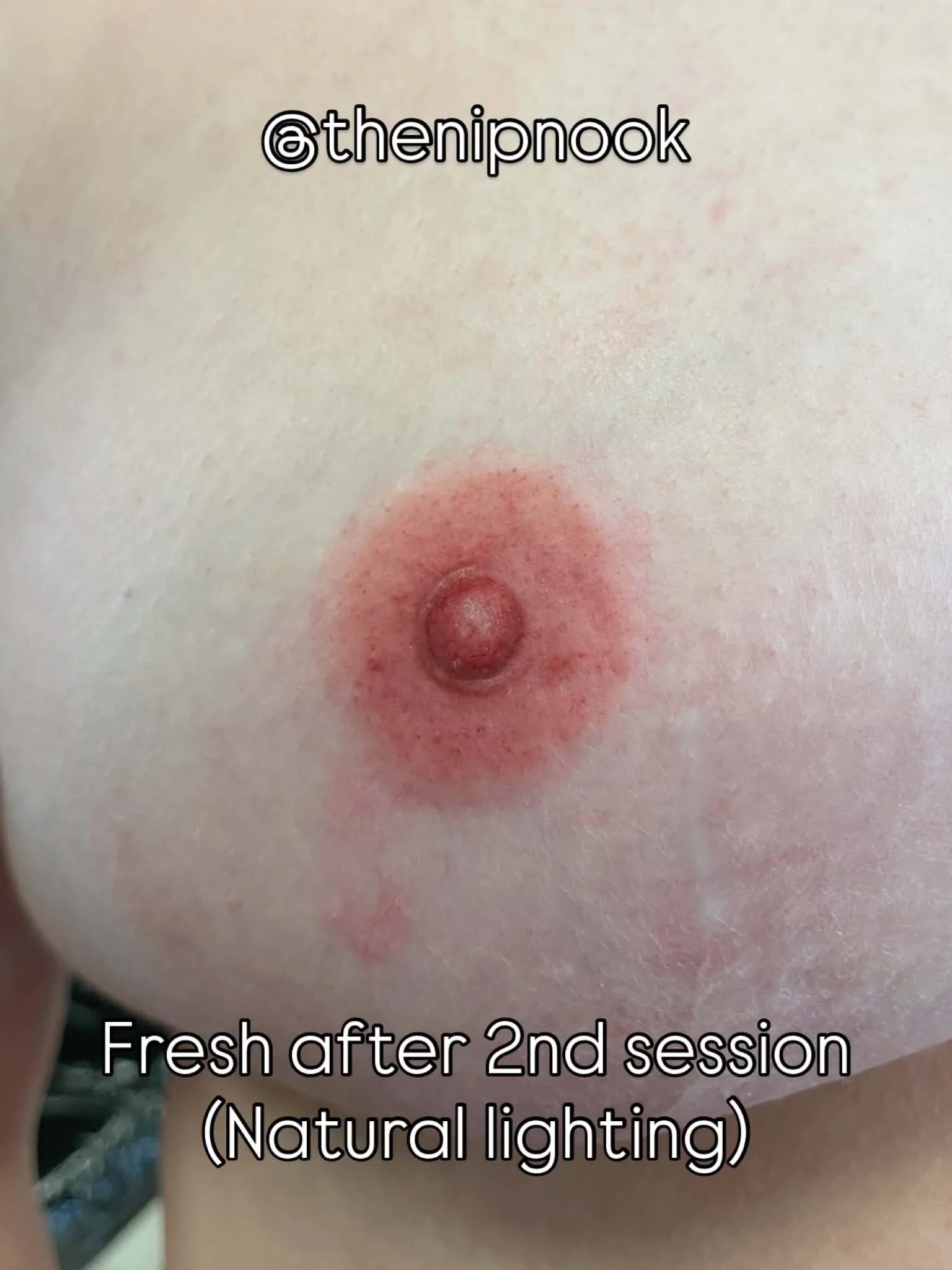 Close-up of a person's nipple and areola with red and irritated skin, taken after a second session of natural lighting treatment.