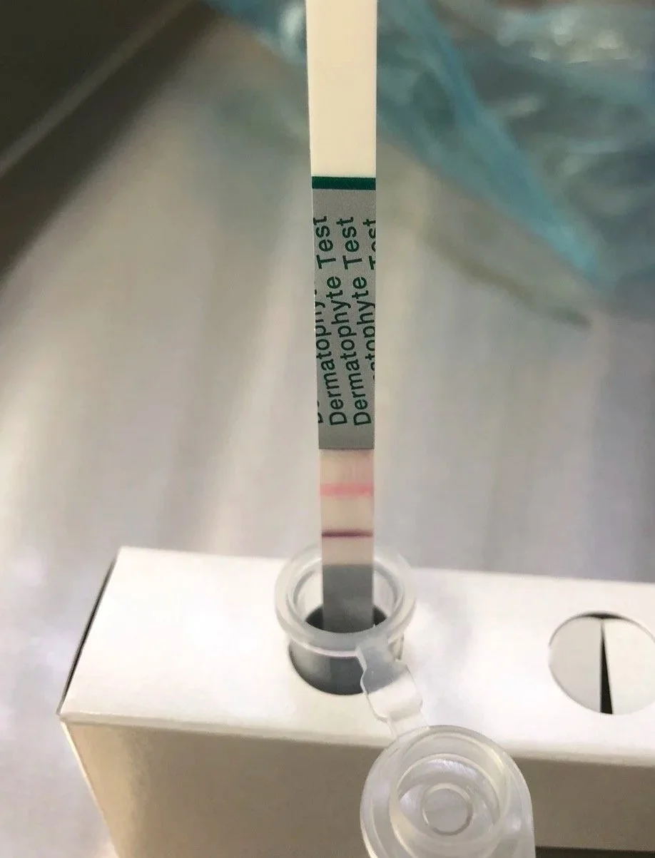 clinical fungal nail testing and diagnosis by a podiatrist in Adelaide