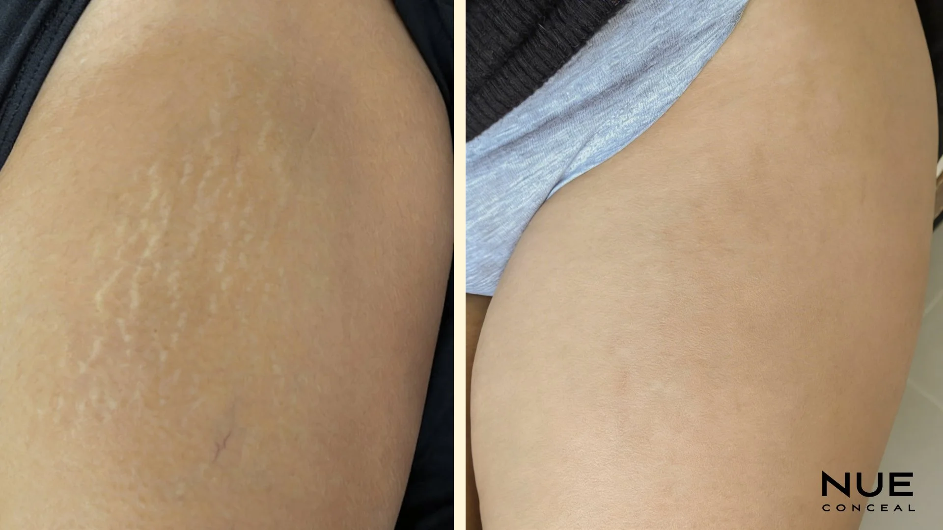 Before and After thigh stretch mark camouflage procedure