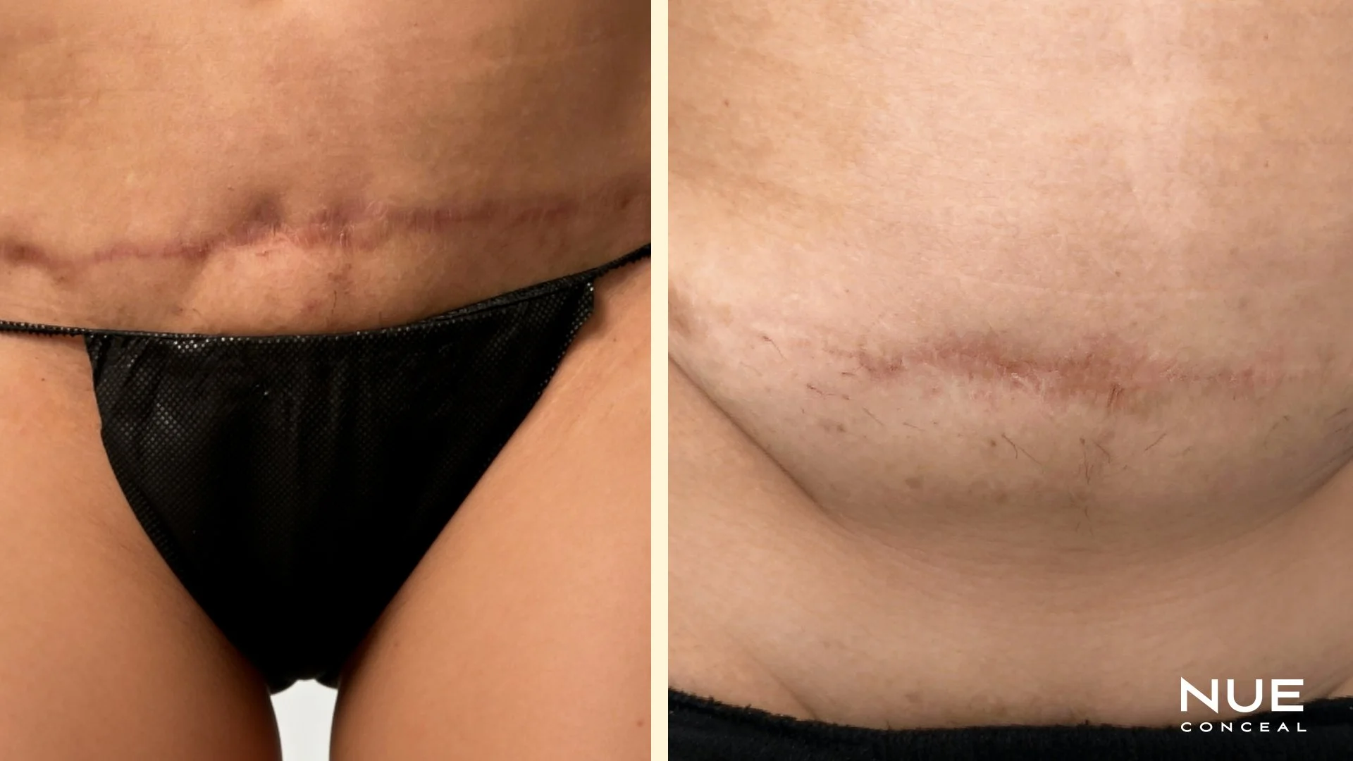 Tummy tuck before and after NUE conceal ISR Revision procedure