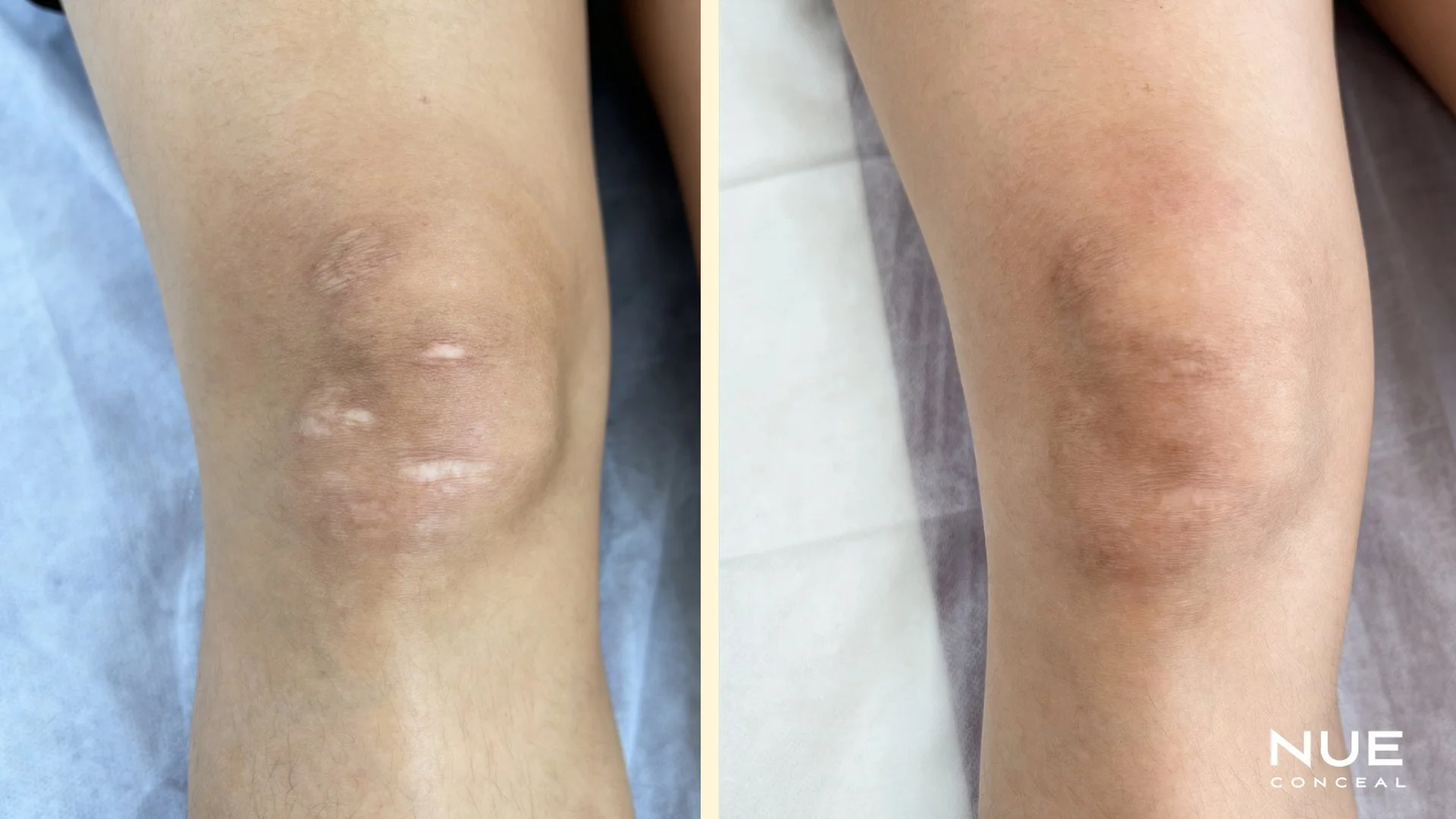 Knee scan before and after camouflage tattoo procedure