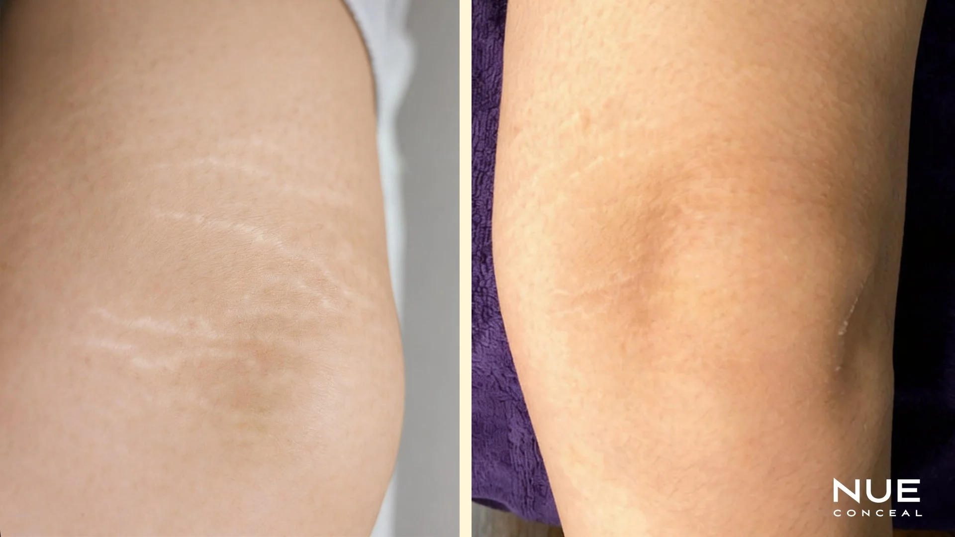 Knee stretch marks before and after camouflage procedure