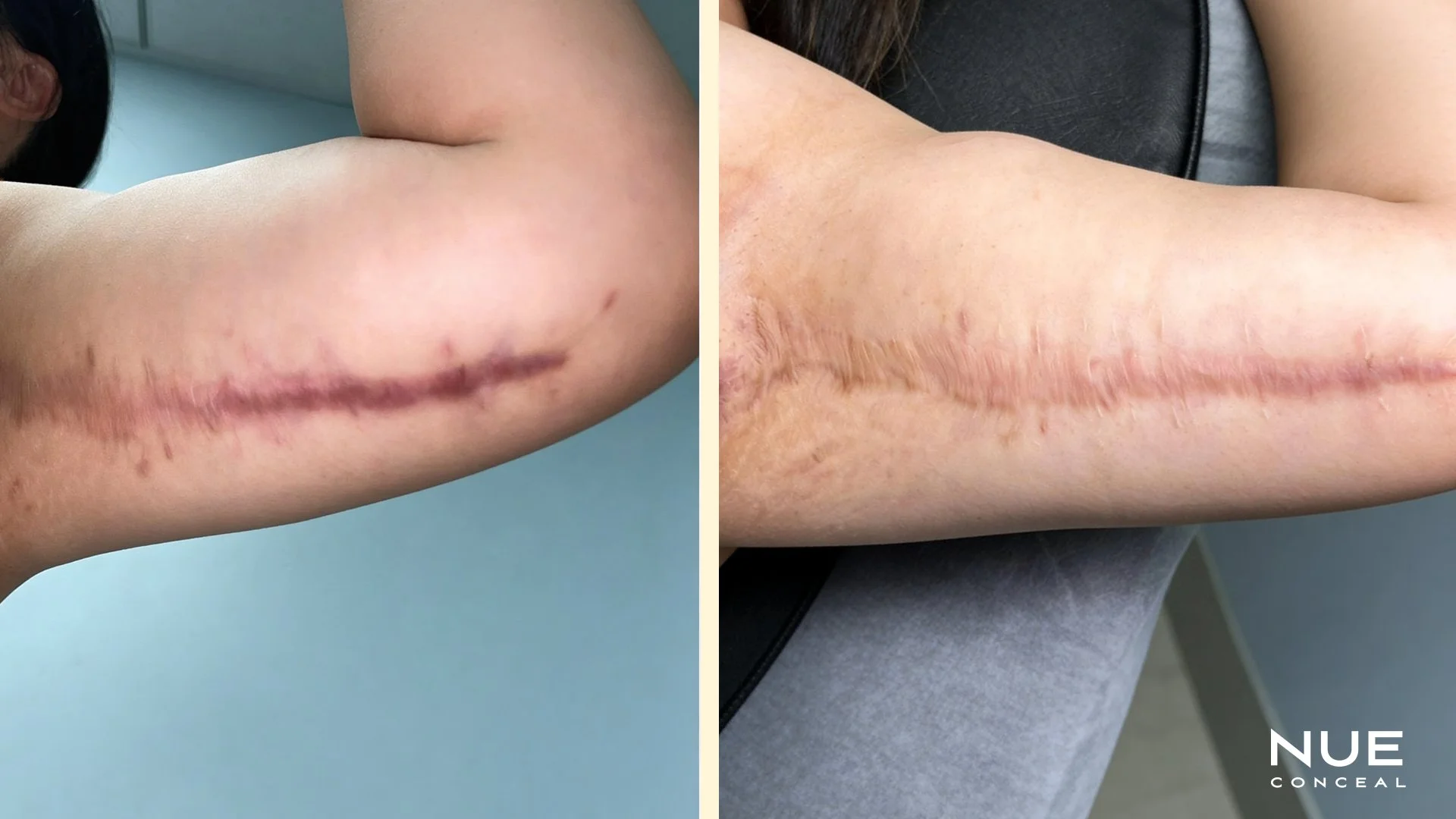 Bicep scar before and after treated with NEU Conceal ISR procedure