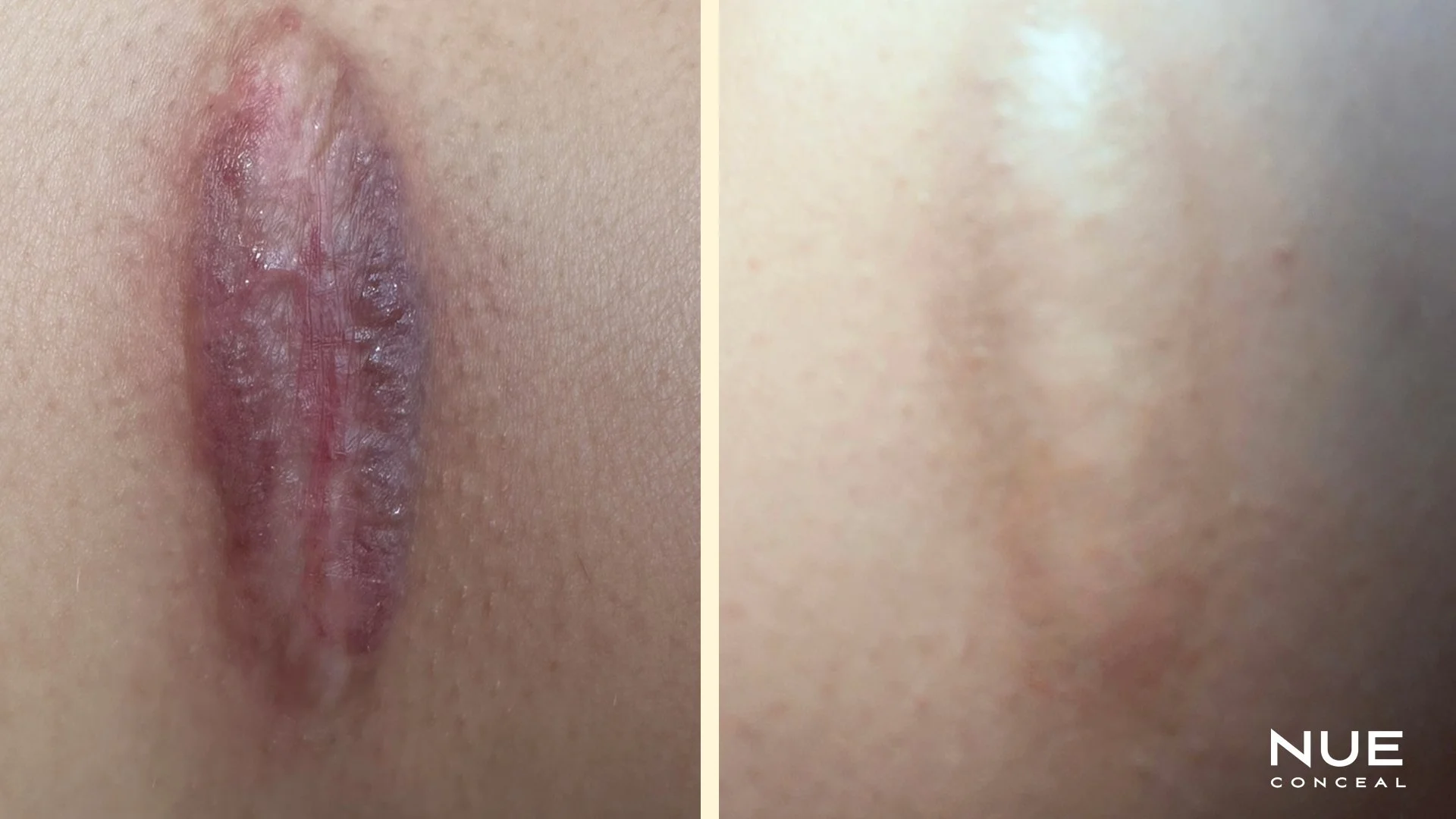 Leg Scar Before and After NUE Conceal ISR revision