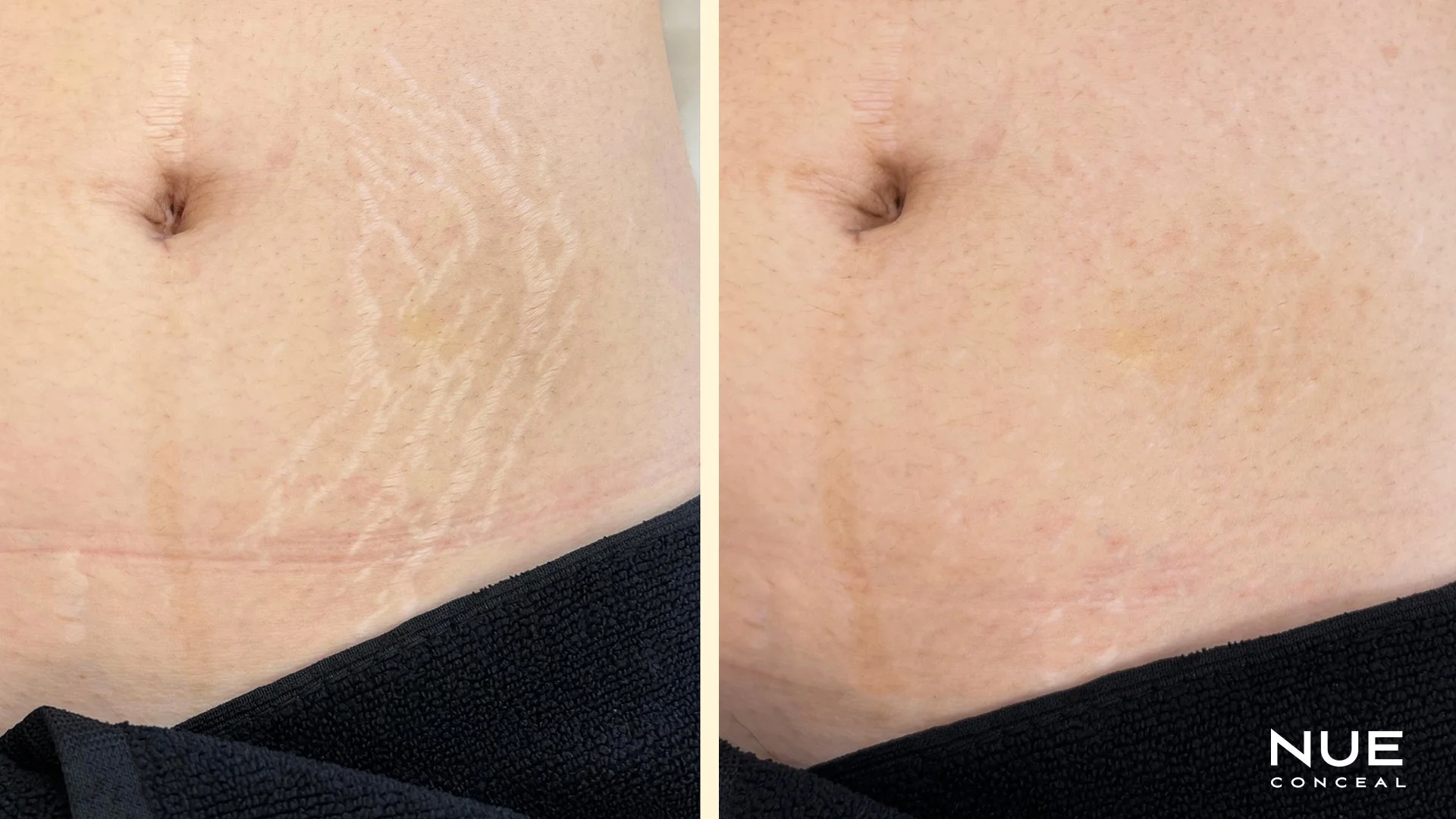 Mid Section stretch marks before and after camouflage tattoo procedure